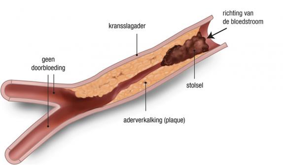 Hartinfarct / Acuut Coronair Syndroom | Hart Long Centrum Leiden